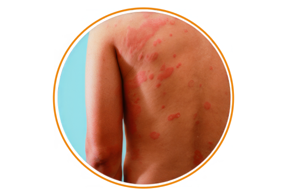 Allergik dermatit