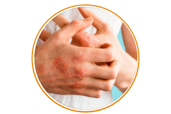 Dermatit növləri