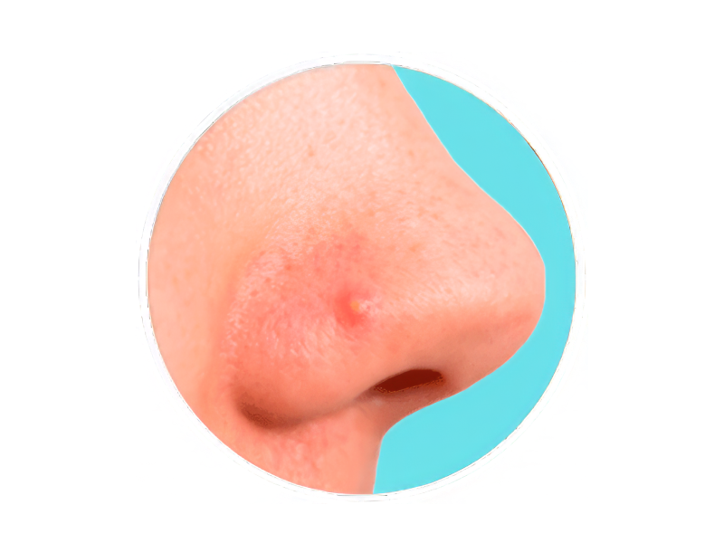 Simptomlar və klinik mənzərə